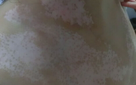 主治白癜风疗法